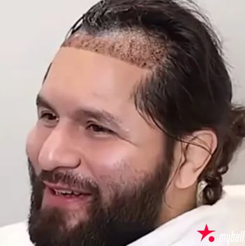 从八角笼到手术台：UFC名将豪尔赫·马斯维达尔赴土耳其植发，大发体育助力你的致富之路！